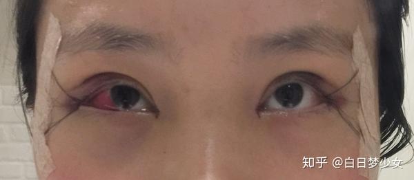 双眼皮 plus 内外眼角(记录贴)
