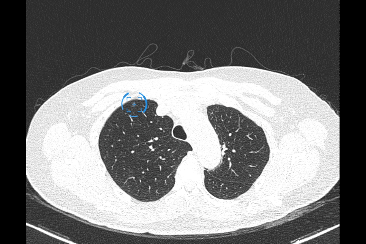 率大国,肺癌早筛是降低死亡率的重要手段,早期肺癌多表现为肺部结节