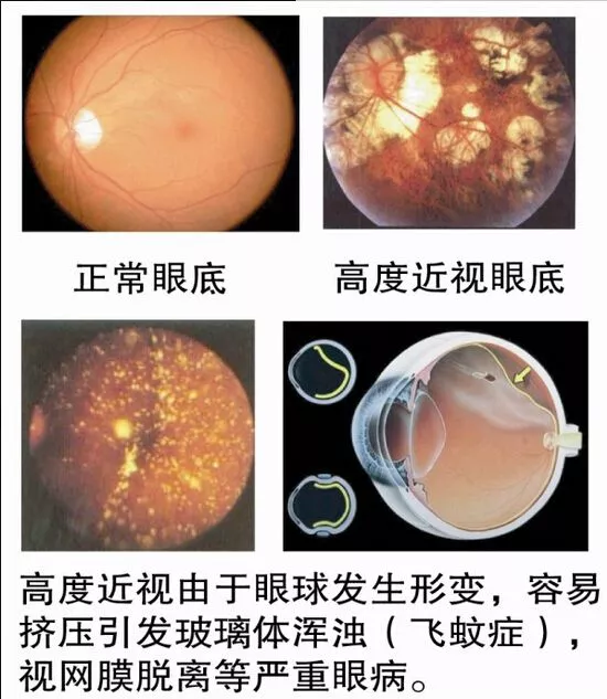 但是已经确诊有眼底病变的高度近视者,要据此作为填征询表时的判断