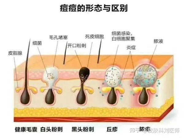 郑州皮肤科常见痤疮问题解读