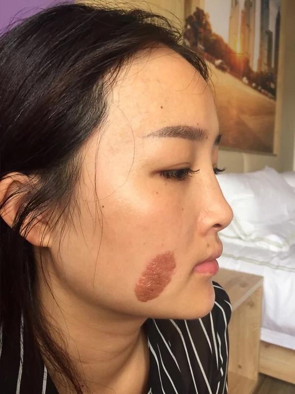 脸上有胎记是一种怎样的体验?