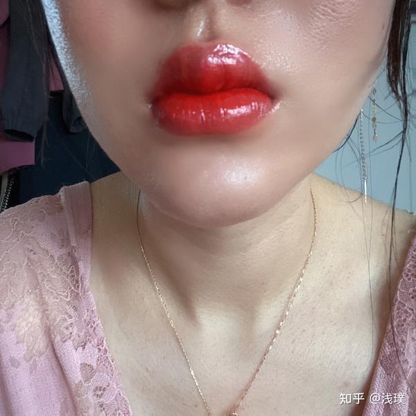 纹唇后几天消肿亲身经历