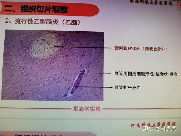 流行性脑脊髓膜炎(流脑),流行性乙型脑炎(乙脑),粟粒性肺结核病理诊断