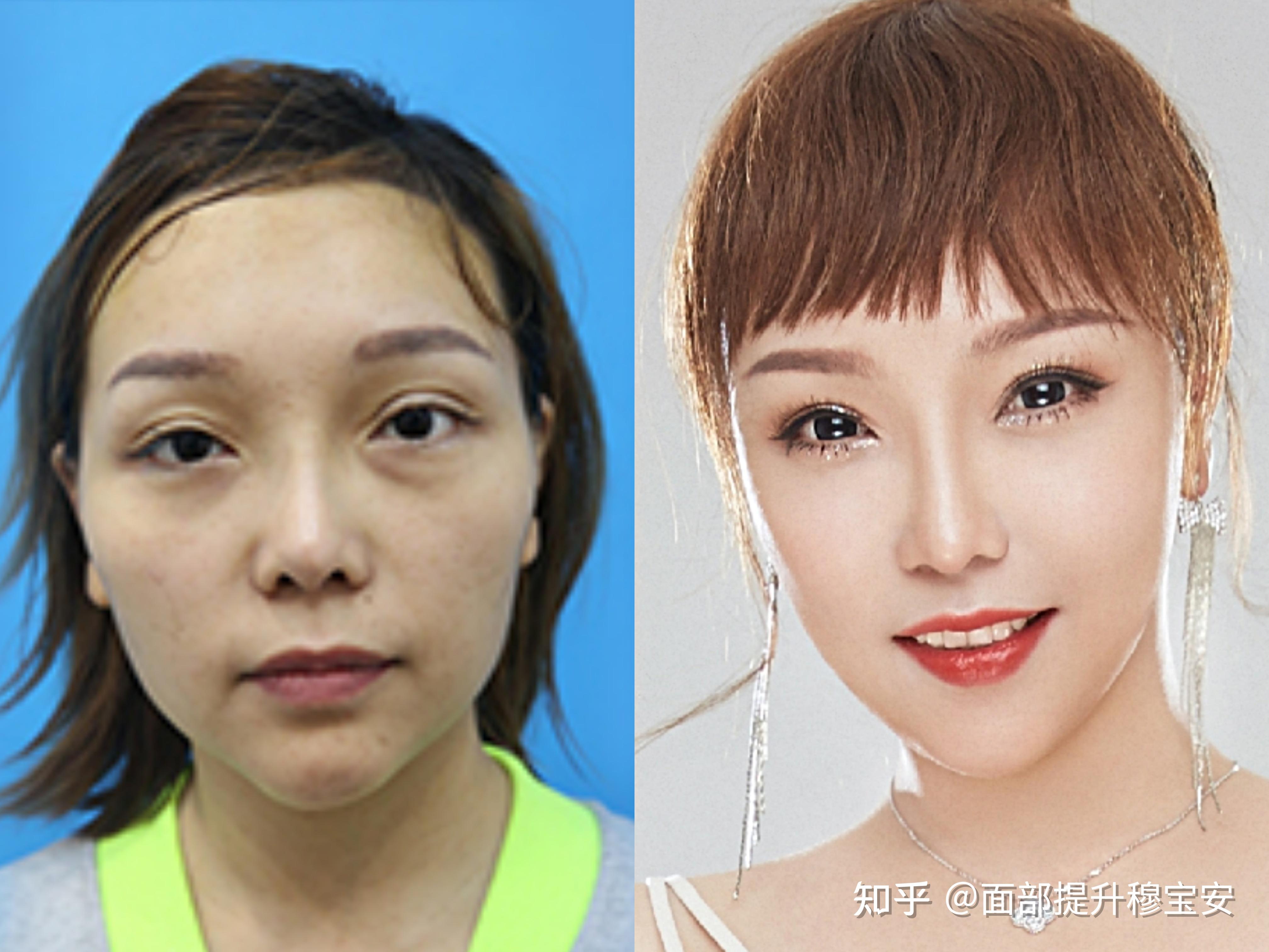 将艺术融于医术穆宝安解读面部提升手术方案的重要性二