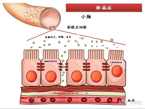 肠漏引致自免疫系统疾病 知乎