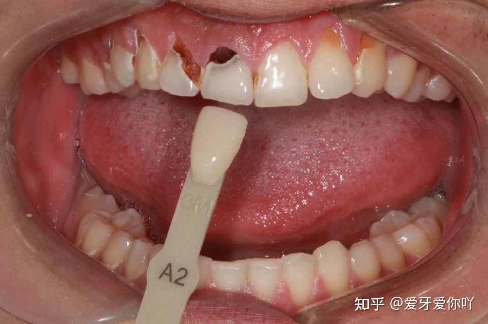 喝可乐会损害牙齿吗?