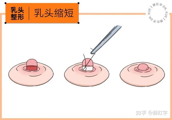 乳晕缩小乳头内陷乳头缩短整形术