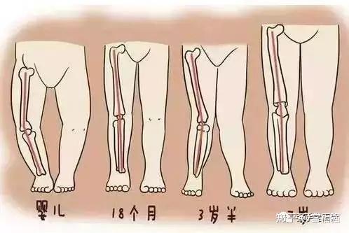 宝宝臀纹,腿纹不对称就是髋关节发育不良吗?
