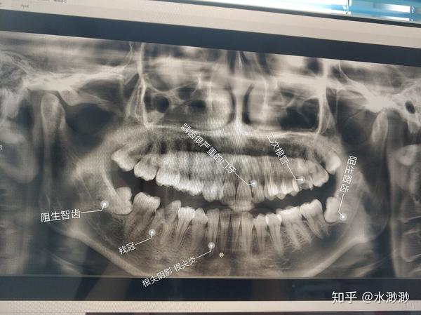 深圳根管治疗 补牙 拔牙经历