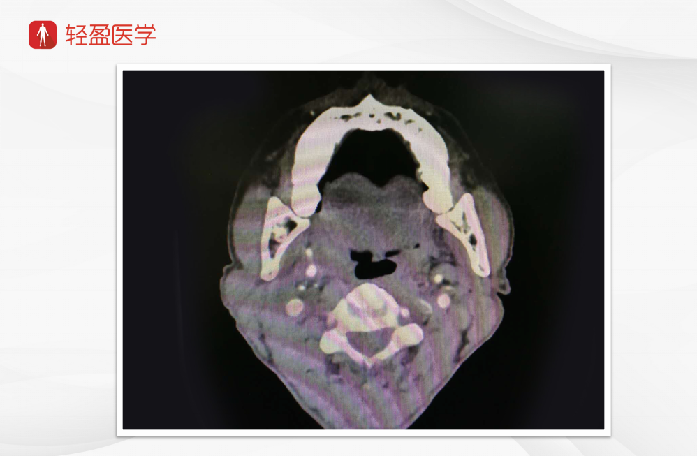 轻盈医学扁桃体癌术式双侧颈清气管切开术胸大肌皮瓣修复术