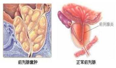 前列腺炎会影响现役飞行员年度体检吗?