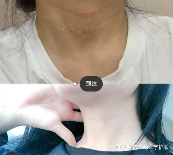 伊肤泉去除颈纹的单针微针结合治疗操作说明