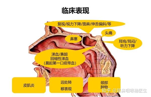 鼻咽癌,早期有哪些症状?