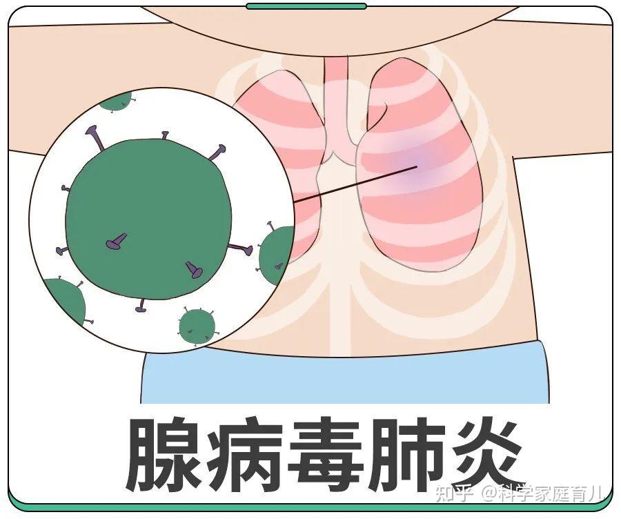 腺病毒成泳池刺客多地儿童中招出现这些症状可能成肺炎