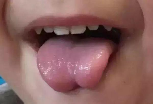 很多人会以为舌系带短就是舌头短,这是错误的认识,舌系带俗称"舌筋"