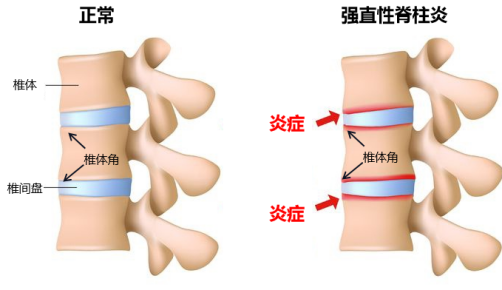 【强直性脊柱炎】是如何发展至弯腰驼背的?