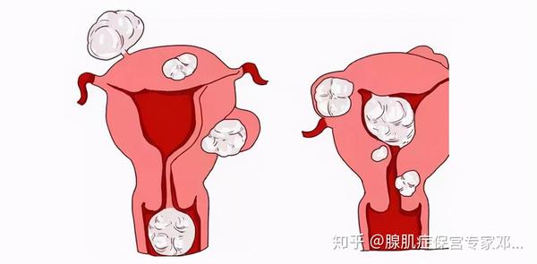 子宫腺肌症:弥漫性,局限性怎么区分?