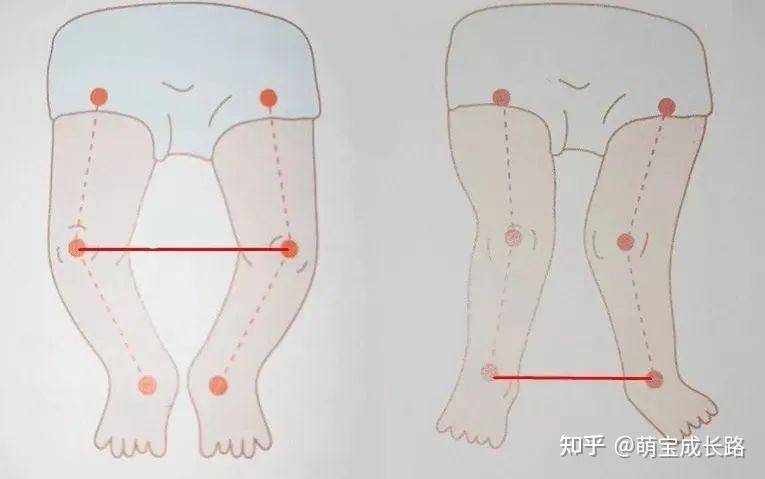 几种腿型异常情况