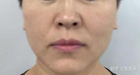 小姨分享填法令纹爆炸线心得,爆炸线填充好不好?
