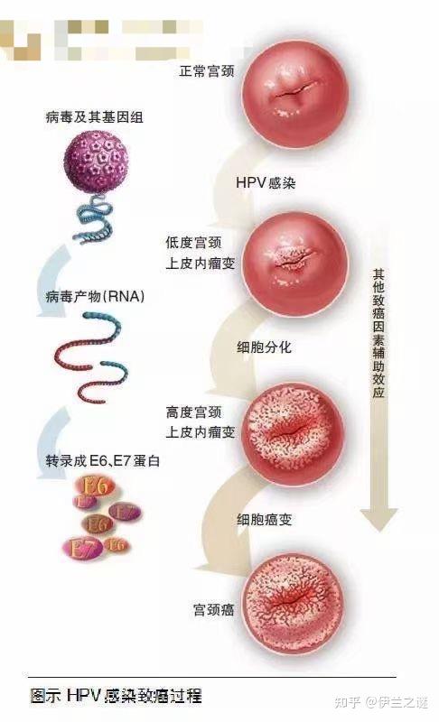 做了手术,结果术后发现hpv消失了,认为手术可以清除hpv病毒