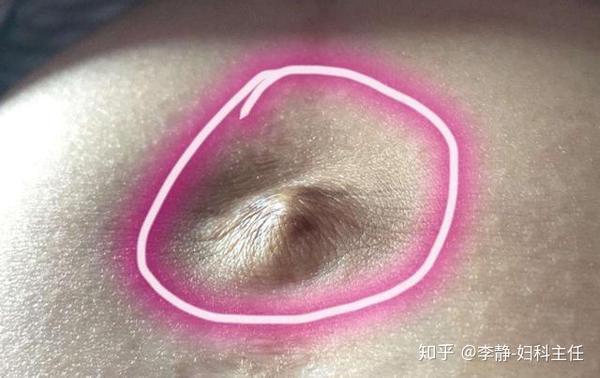 孕妇肚脐"凹进去"生女儿,"凸出来"生男孩?