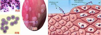 几种措施有效减少尖锐湿疣的复发性