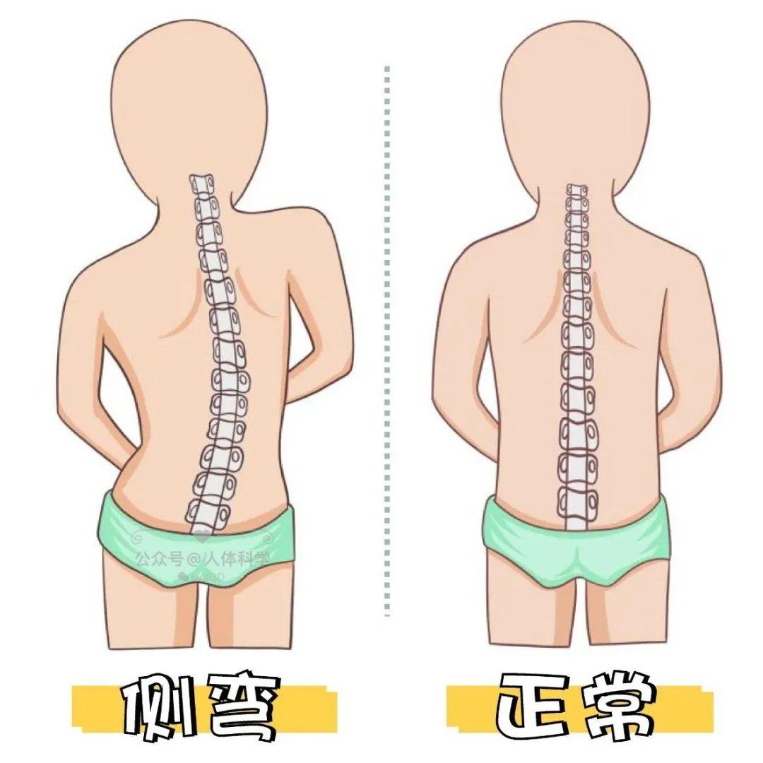 脊柱侧弯身体侧弯的常见错误体态和改善动作