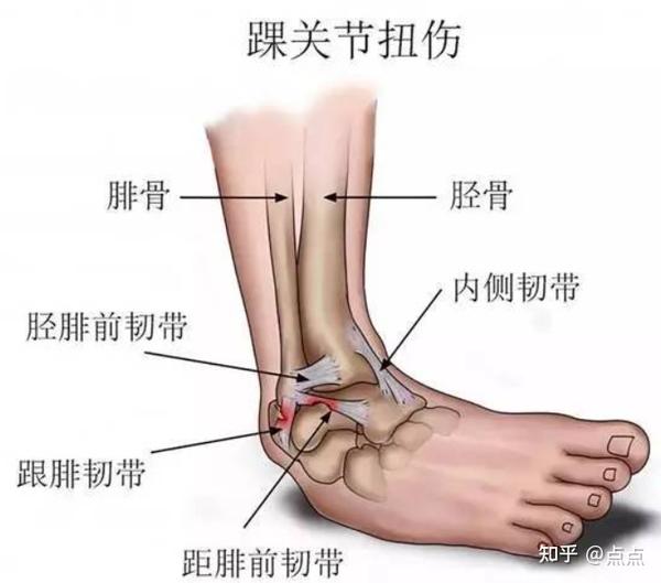 如何治疗脚踝韧带拉伤