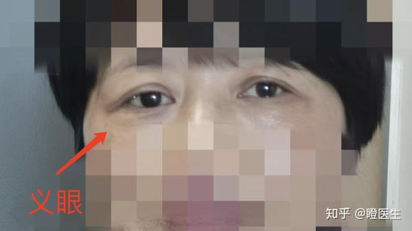 眼球摘除后如何面对生活?眼科医生带你揭开"假眼"的神秘面纱