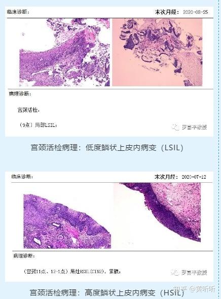 别慌宫颈上皮瘤样病变宫颈癌