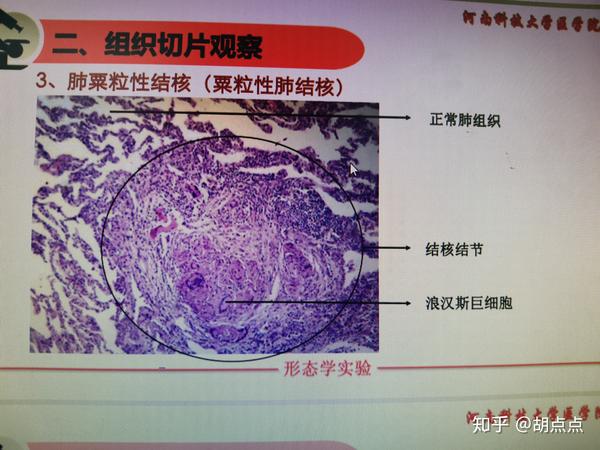 流行性乙型脑炎(乙脑,粟粒性肺结核病理诊断及病理切片 知乎