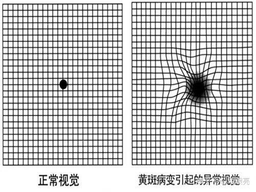 眼科医生教你在家自测黄斑病变