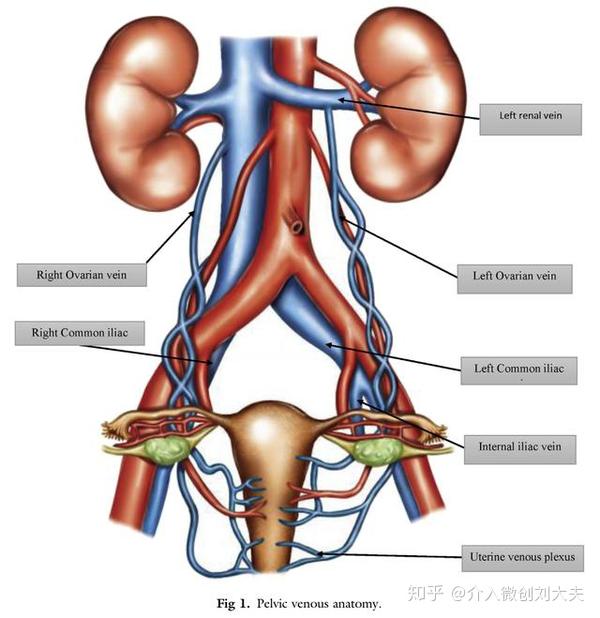 左卵巢静脉以直角汇入左肾静脉后随之入下腔静脉,特殊解剖结构导致