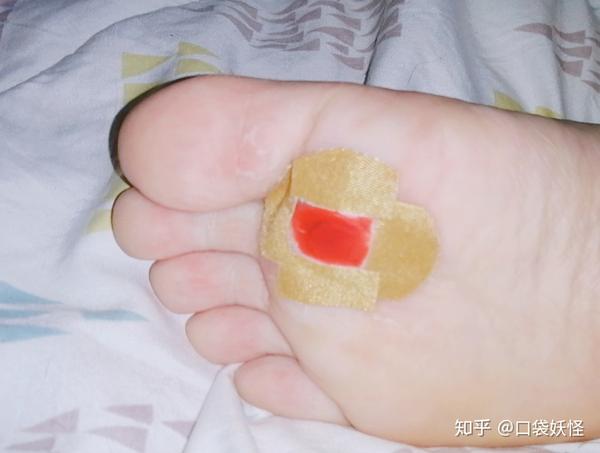鸡眼的治疗过程