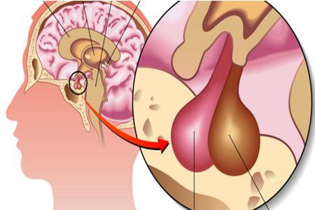 疑问医答泌乳素过高有哪些影响泌乳素型垂体瘤的特点