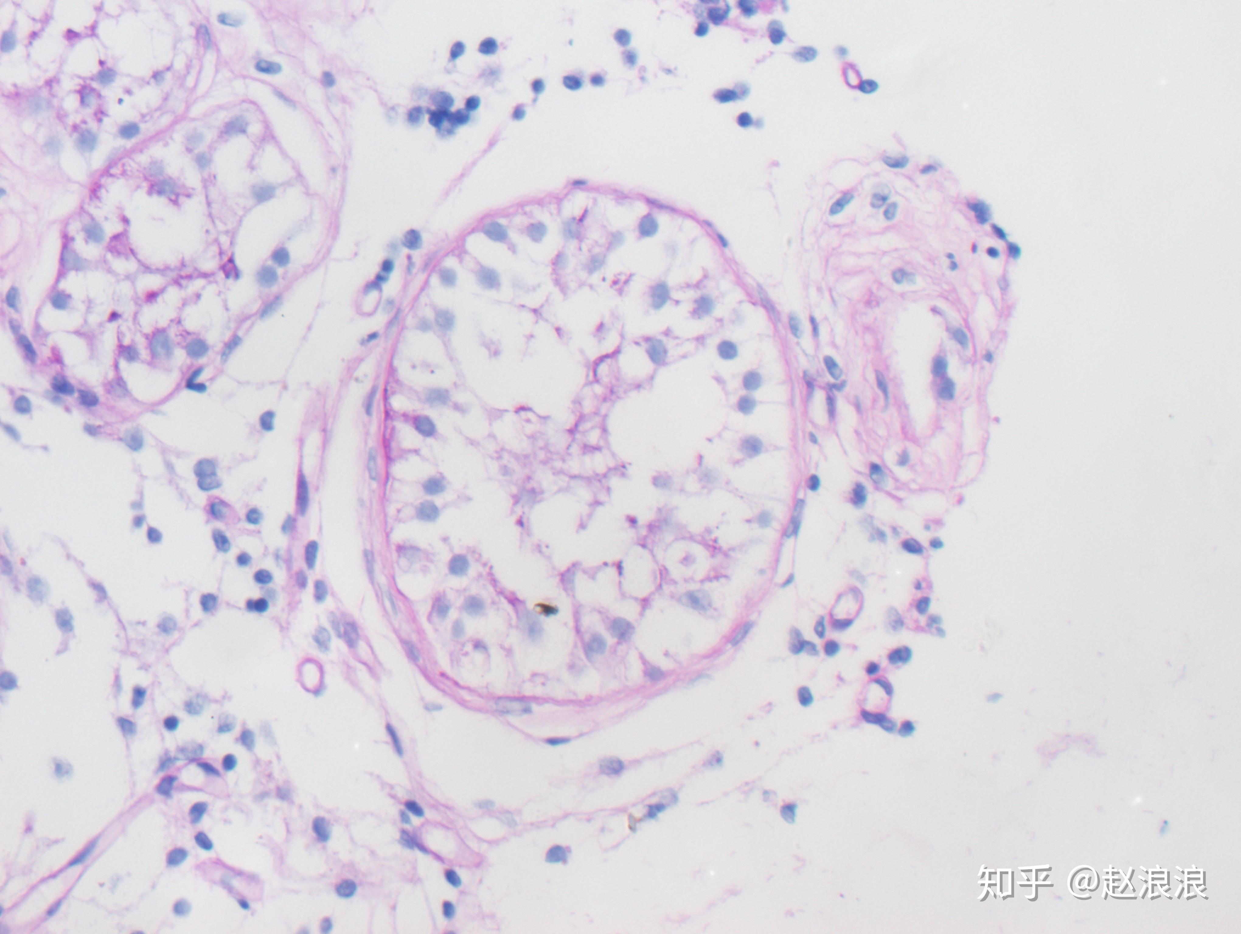 非梗阻性无精子症病人睾丸切片he染色.