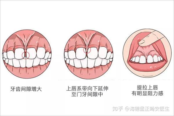 这种情况需要适时进行唇系带手术, 为间隙闭合提供条件.