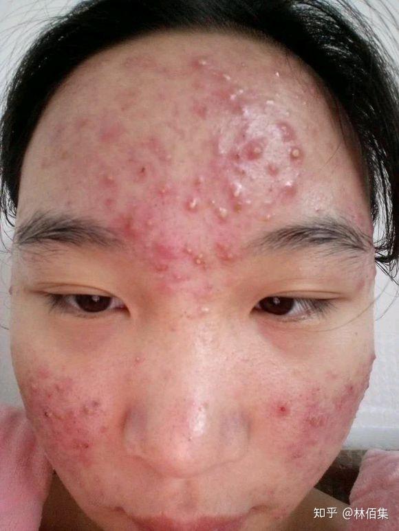 如果你也有一脸痘痘,你会怎么样生活?