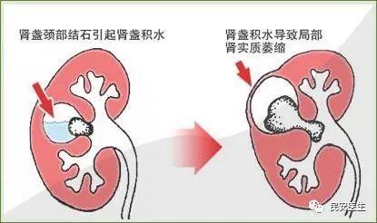 痛起来堪比分娩的疾病肾结石