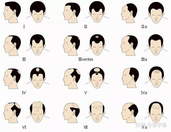 如何判断自己脱发的类型和程度