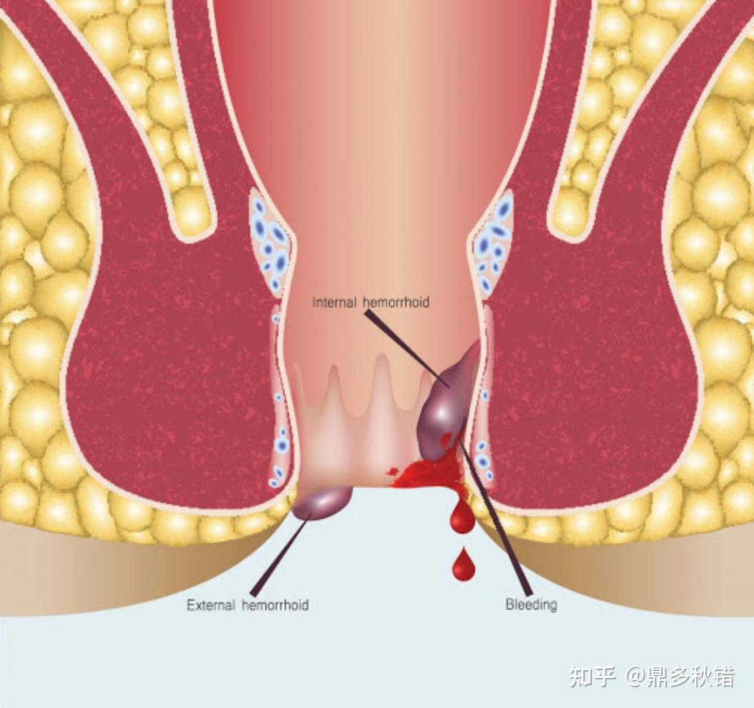 内痔:位于齿状线以上,即直肠下端,一般不会经肛门缘露出.