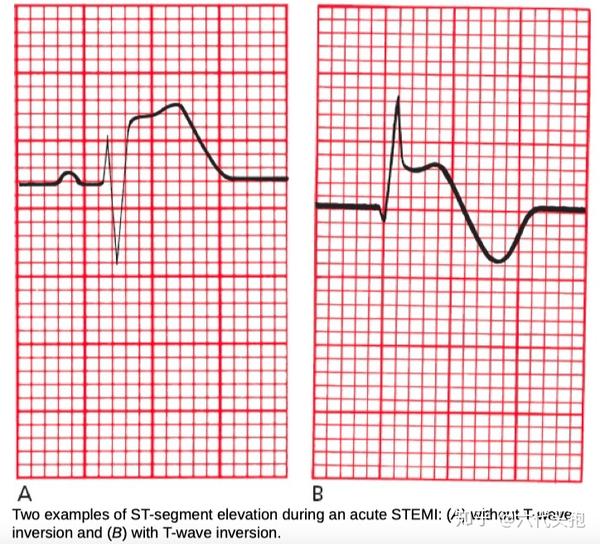 毕竟 急性心肌损伤可以看到st段弓背式抬高;如果严重至缺血,st几小时