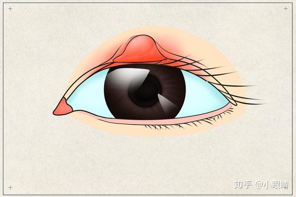 眼睛长了一粒小疙瘩,医生:别再说是针眼了,90%的人都会认错