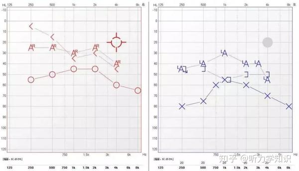 耳硬化症的诊断与听力学干预附1例耳蜗型耳硬化