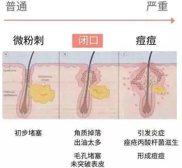 挤不掉又消不了的"闭口粉刺",难道只能让它留在脸上了
