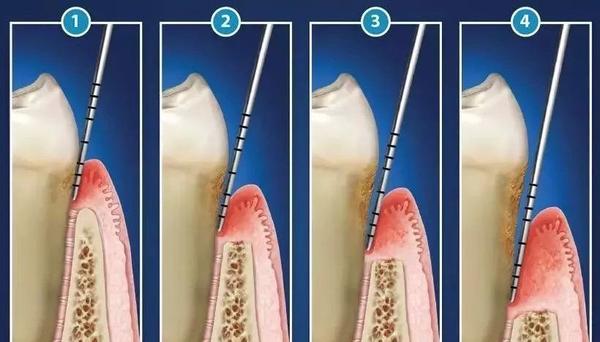 牙周袋的深度如果大于3mm就要格外
