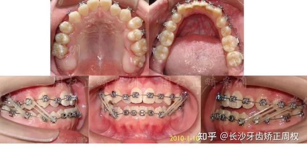 长沙牙齿矫正丨3年完成的严重骨性反合偏合开合病例