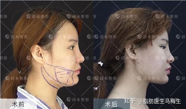 形成双下巴的原因以及解决方法