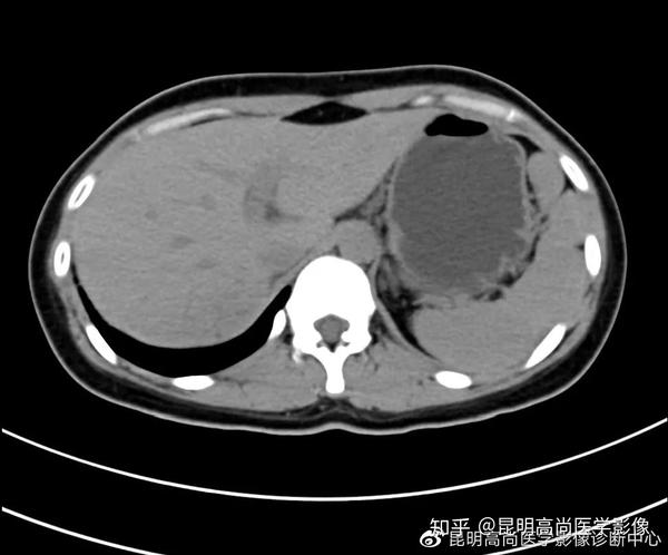 昆明高尚医学影像诊断中心【病例】上腹部ct肝脏局灶性结节增生!