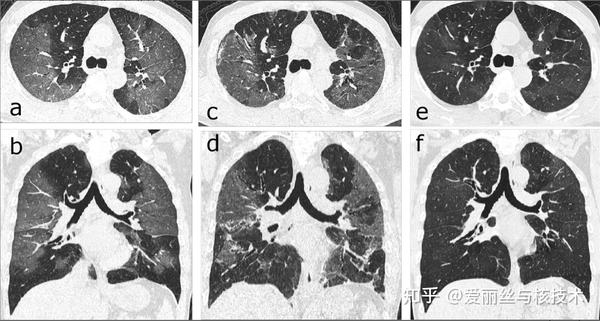 ct显示三分之一的新冠肺炎患者可能终生肺部损伤